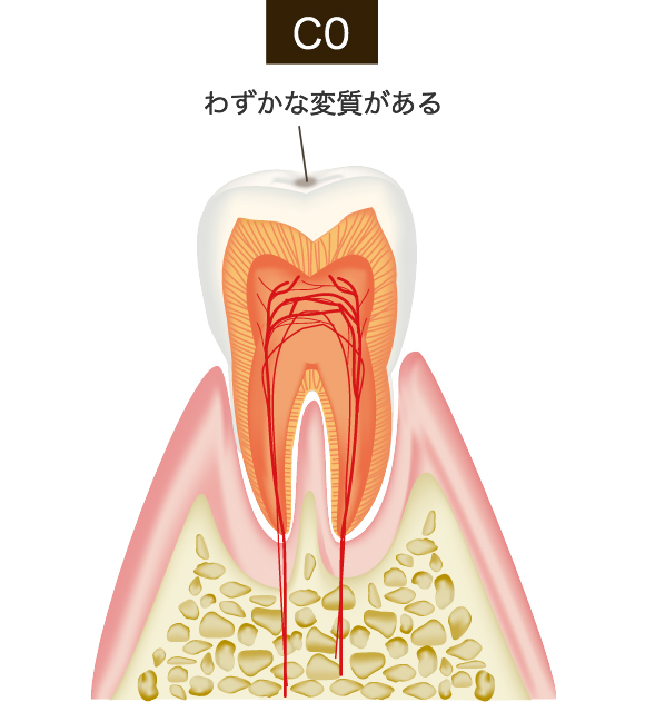 痛くなくても要注意　むし歯の4段階