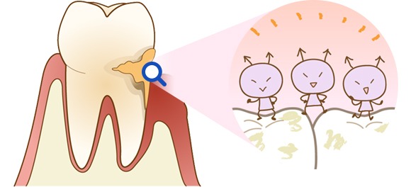 歯周病の原因は？